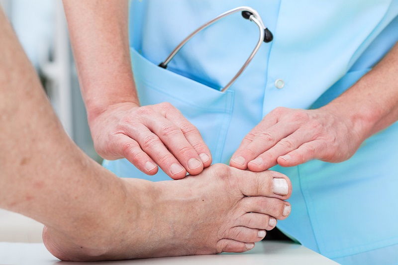 How to Prevent Bunions