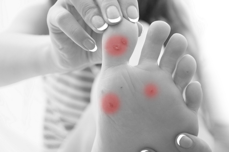What Are Plantar Warts—and How Do You Get Rid of Them